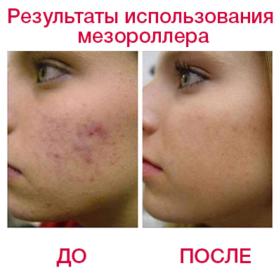 МЕЗОРОЛЛЕР - ПРИБОР ДЛЯ УХОДА ЗА КОЖЕЙ ЛИЦА